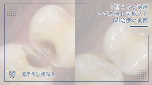 「削らない治療って本当に可能？」MI治療の実際